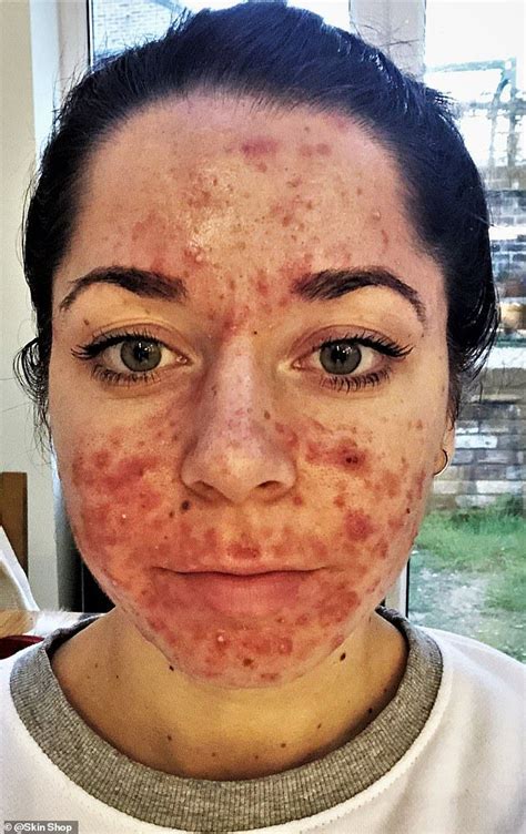 Personal trainer shares her striking before and after acne pictures ...