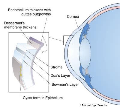 The cornea is comprised of 3 layers of tissue