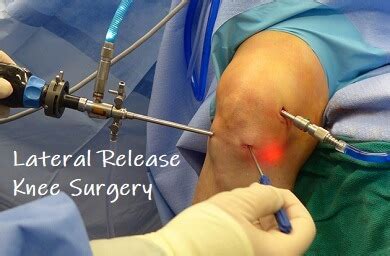 Lateral Release Surgery What To Expect - mapametawan