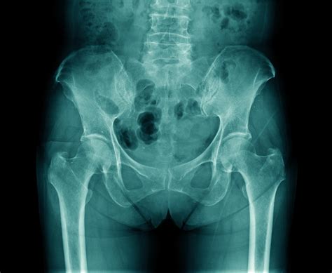 Is your hip replacement surgery medically necessary? How can you obtain a second opinion ...