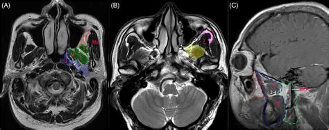 Temporal Fossa And Infratemporal Fossa