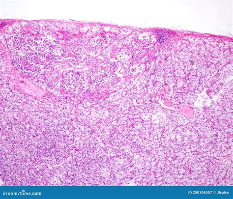 Human Kidney. Clear Cell Renal Carcinoma Stock Image - Image of cell ...