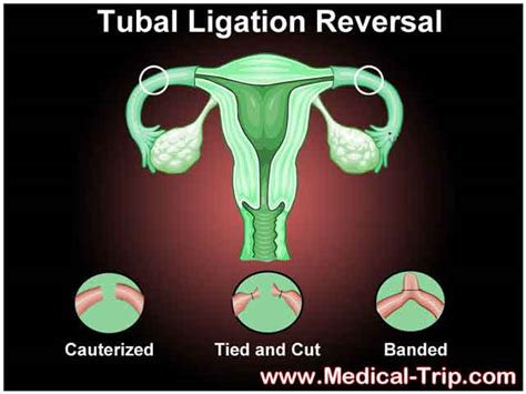 Tubal Ligation Reversal in Mexico | Medical Trip