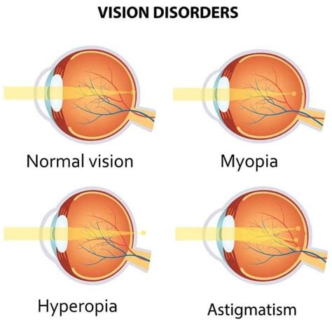 Types of ametropia include myopia, hyperopia and astigmatism. They are frequently categorized as ...