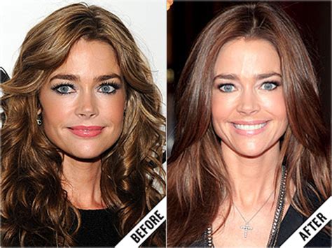 Denise Richards Plastic Surgery Face Before And After Photos