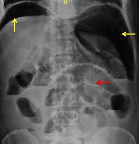 Tension Pneumoperitoneum as a Result of Diastatic Perforation | Cureus