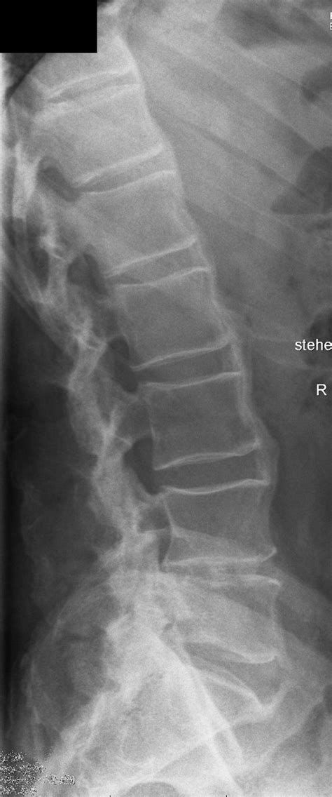 Diffuse idiopathic skeletal hyperostosis | Norway | PDF | PPT| Case Reports | Symptoms | Treatment