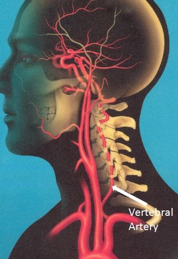 Transient Vertebrobasilar Insufficiency - SeattleNeurosciences.com