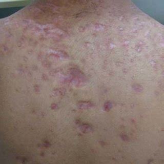 (PDF) Acne fulminans incapacitante