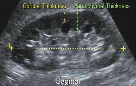 Kidney Ultrasound Images Normal