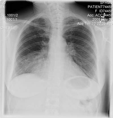 An infrequent cause of chronic cough - Clinical Advisor