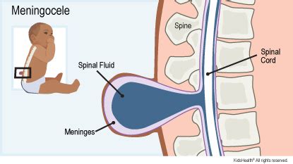 Meningocele