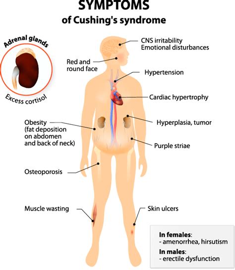 Adrenal Cushing's Syndrome | Saint John’s Cancer Institute