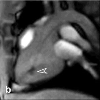 Real-time magnetic resonance imaging-based endomyocardial biopsy... | Download Scientific Diagram