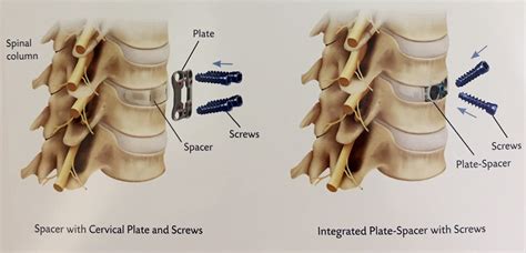 Cervical Spine Fusion - Spinecare Medical Group