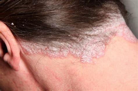 Scabs on Scalp: Causes, Treatment & Remedies | Treat, Cure Fast