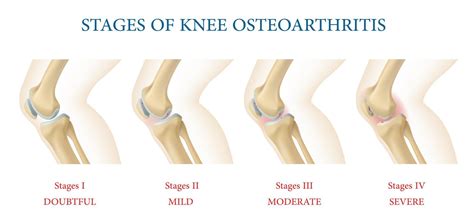 Knee joint osteoarthritis stages infographics 21565064 Vector Art at Vecteezy