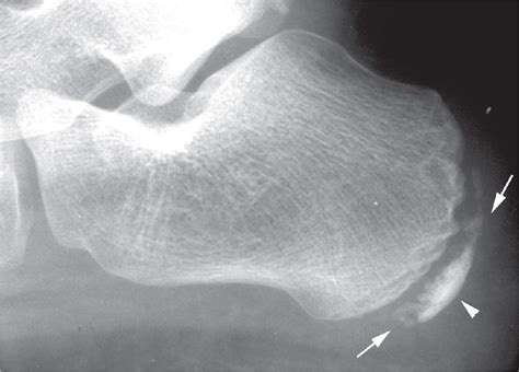 17: Osteonecrosis and Osteochondrosis | Musculoskeletal Key