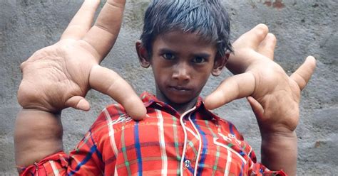 'Boy with the World's Biggest Hands' measuring 33cm has surgery to ...