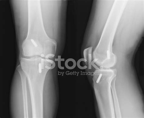 X-Ray Of Knee With Acl Reconstruction Stock Photo | Royalty-Free ...