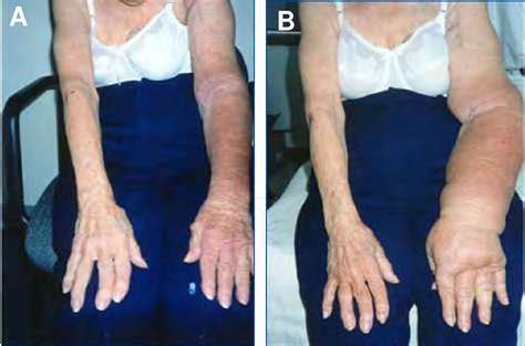 Figure 2 from 3 Arm Lymphedema as a Consequence of Breast Cancer ...