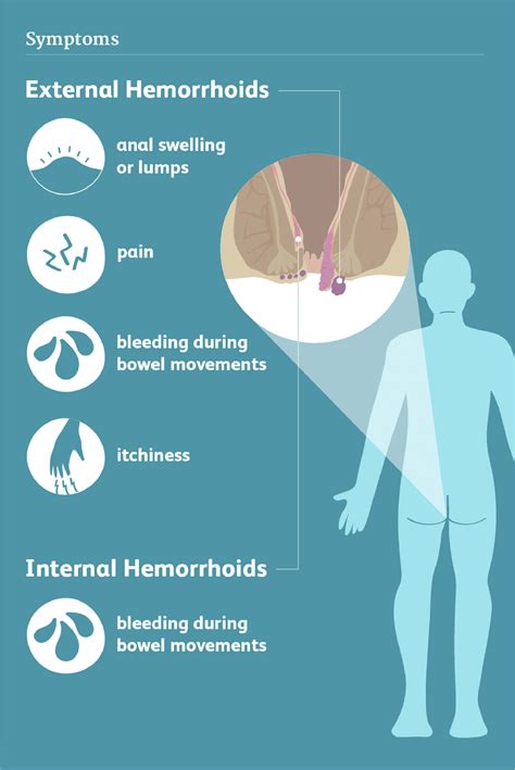 Symptoms you are likely to feel during Piles