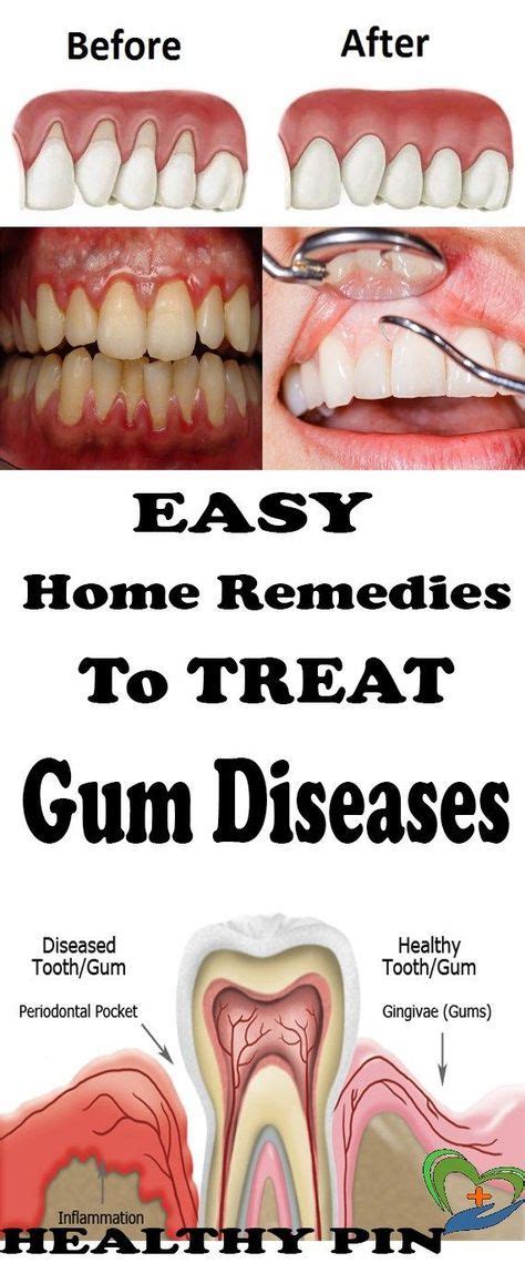 Home Remedies for Gum Disease.. #oralgumremedies | Gum disease ...