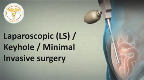 Recovery after Laparoscopic Inguinal / Groin hernia surgery. What to expect? – Professor Amir Nisar