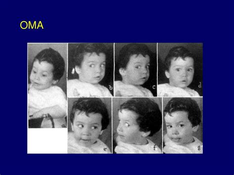 PPT - Ocular Motor Apraxia PowerPoint Presentation - ID:598136