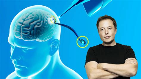 Elon Musk anunció que Neuralink implantó por primera vez un chip ...