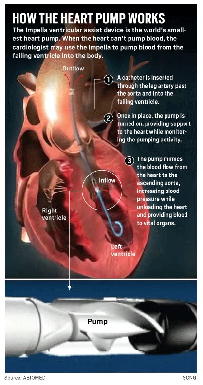 California hospital's quest for a new heart pump device ends just in ...