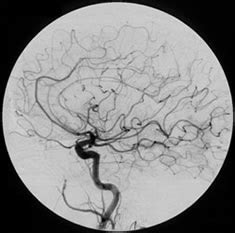 Brain (Carotid Angiogram) - Imaging Glossary - Patients - UR Medicine Imaging Sciences ...