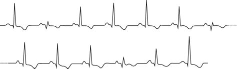 Eletrical alternans: the ECG in pericardial effusion & cardiac tamponade – ECG learning