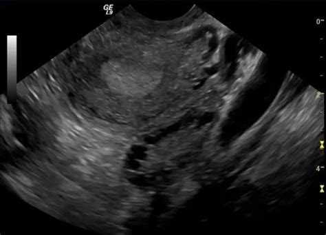 Ovarian Fibroma - Causes, Symptoms, Types And Treatment Of Ovarian ...