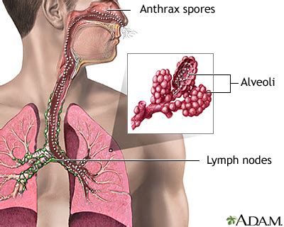 Anthrax | UF Health, University of Florida Health