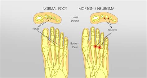 Morton's Neuroma Anatomy