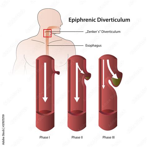 Diverticulum epiphrenic eps vector illustration Stock Vector | Adobe Stock