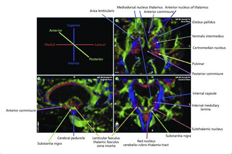 DTI. Colored fractional anisotropy map at 1.5T indicates fiber... | Download Scientific Diagram