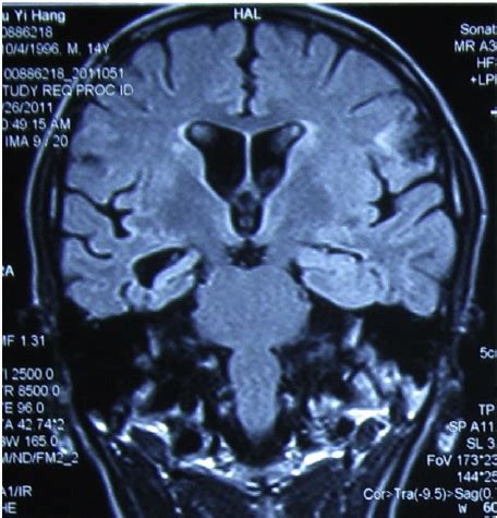 Mesial temporal lobe sclerosis in the right temporal lobe. | Download Scientific Diagram