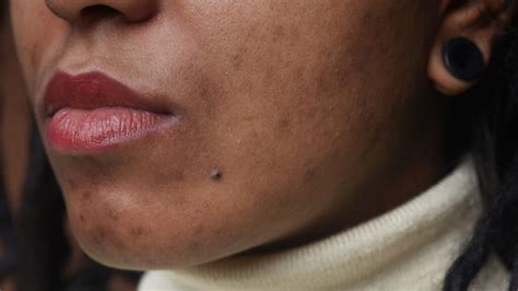 Hyperpigmentation: Types, treatment, and causes (2022)