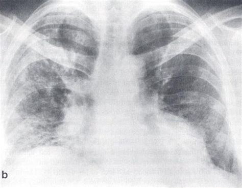 Interstitial Pneumonia X Ray