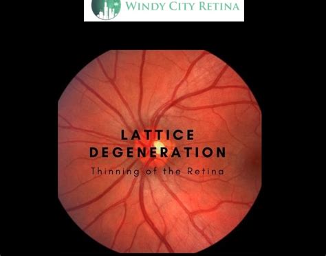 An Overview on Diagnosis and Treatment of Lattice Degeneration