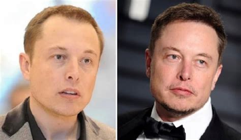 Elon Musk Before and After Plastic Surgery: Hair transplant