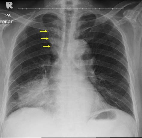 Lung cancer: squamous cell carcinoma – Radiology Cases