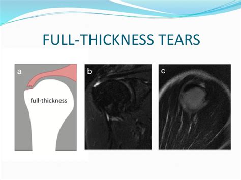 Tears at the rotator cuff footprints: imaging characteristic on MRI and ...