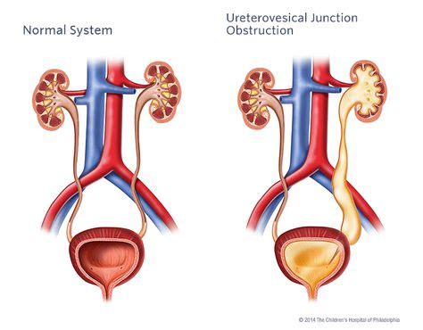 UVJ obstruction | Sonography Student | Kidney disease stages, Kidney failure, Kidney infection