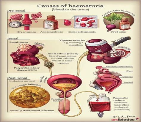 Hematuria