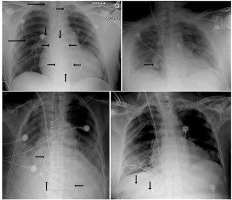 Pulmonary Artery Catheter Tip