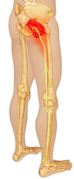 Piriformis Syndrome - Back in Action