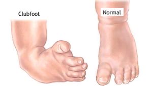 Club Foot (Talipes Equinovarus) - Ankle, Foot and Orthotic Centre